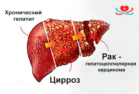 Рисунок печени в различных стадиях заболеваний